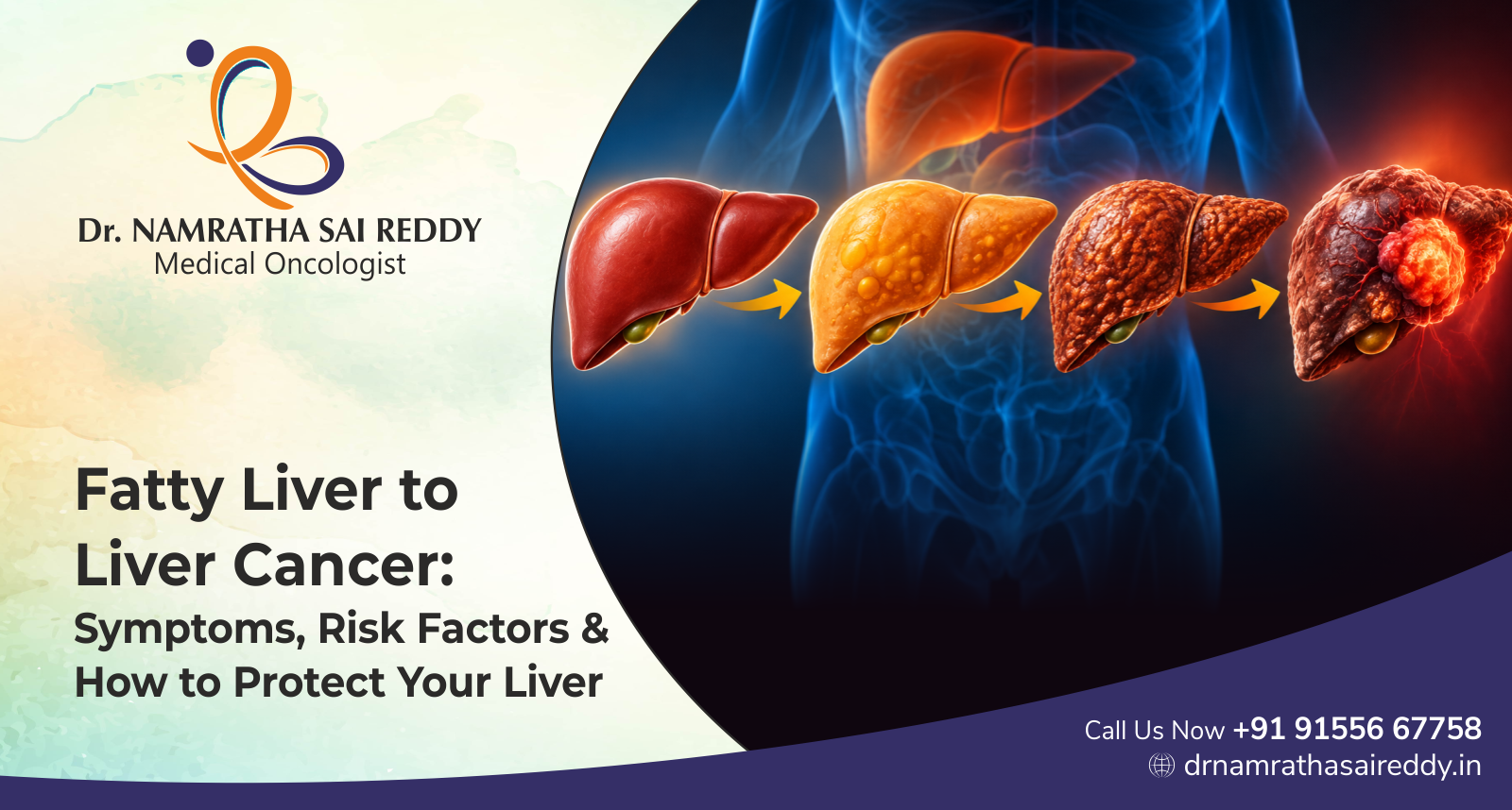 Fatty Liver to Liver Cancer